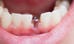 A placed dental implant and its abutment