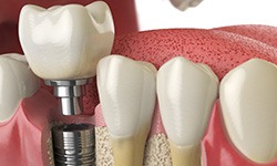 A 3D illustration of a dental implant and its final restoration