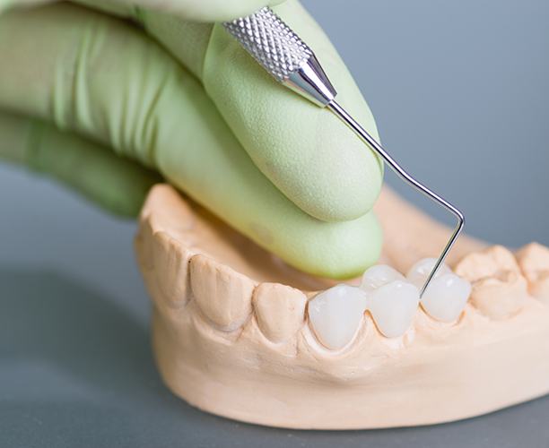 Green gloved hand poking sample dental bridge on cast